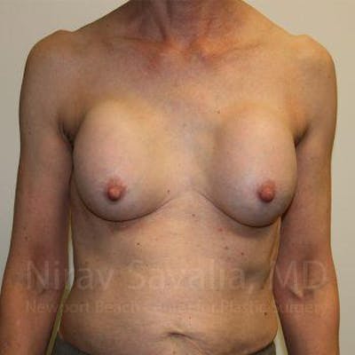 Breast Explantation En Bloc Capsulectomy Before & After Gallery - Patient 1655447 - Before