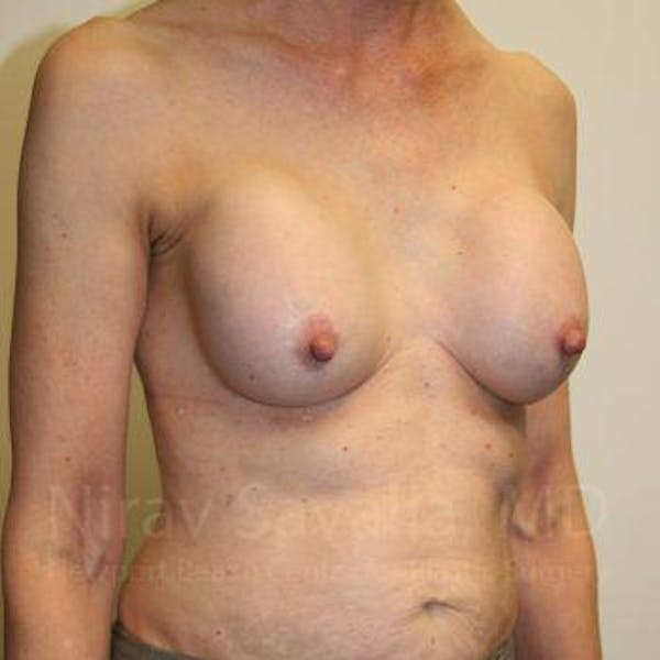 Breast Explantation En Bloc Capsulectomy Before & After Gallery - Patient 1655447 - Before