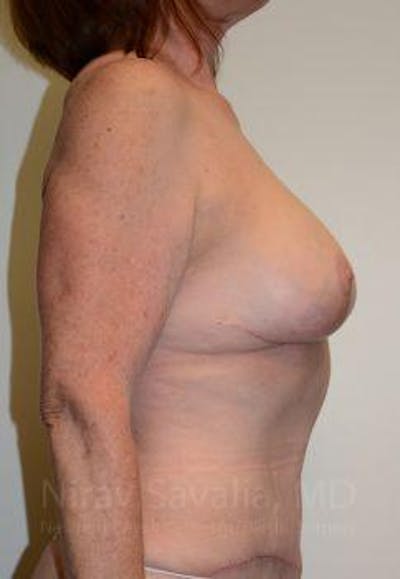Oncoplastic Reconstruction Before & After Gallery - Patient 1655458 - After