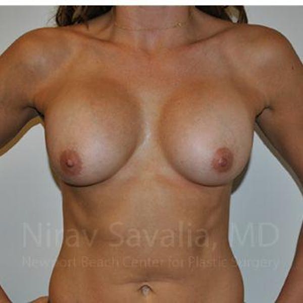 Breast Explantation En Bloc Capsulectomy Before & After Gallery - Patient 1655470 - Before