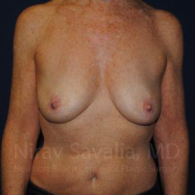Breast Explantation En Bloc Capsulectomy Before & After Gallery - Patient 1655481 - Before