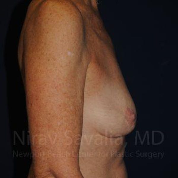 Breast Lift with Implants Before & After Gallery - Patient 1655481 - Before