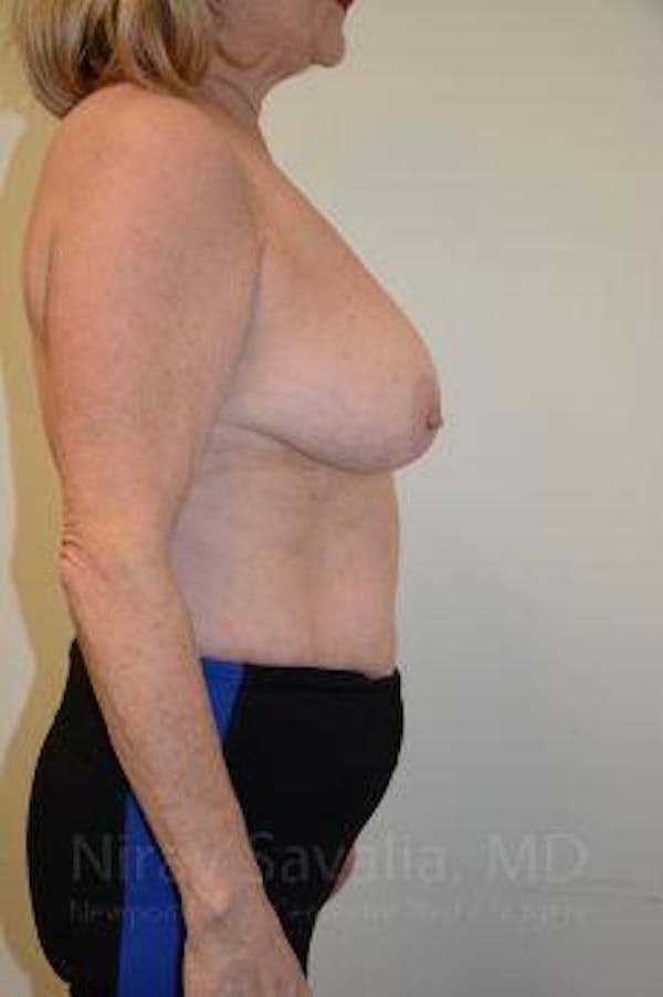 Breast Augmentation Before & After Gallery - Patient 1655501 - Before