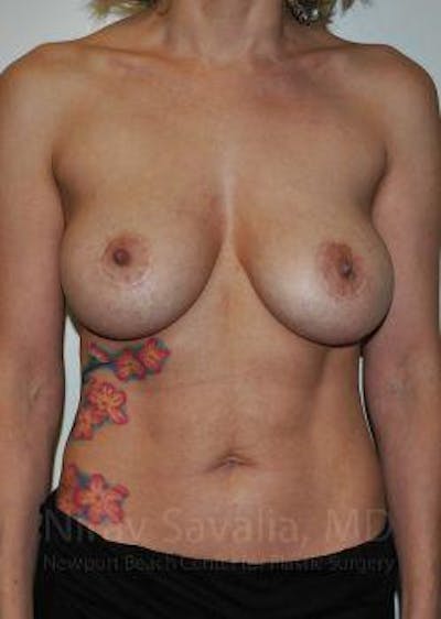 Breast Lift with Implants Before & After Gallery - Patient 1655507 - Before