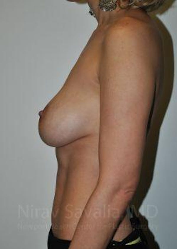 Breast Lift with Implants Before & After Gallery - Patient 1655507 - Before