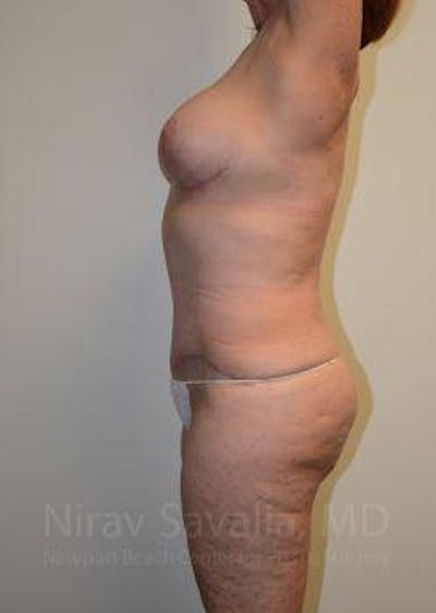 Breast Lift without Implants Before & After Gallery - Patient 1655509 - After