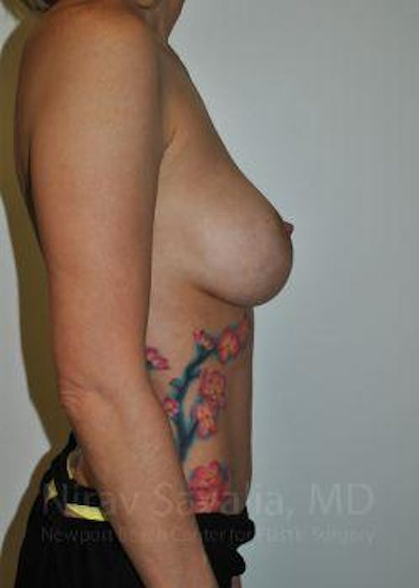 Breast Lift with Implants Before & After Gallery - Patient 1655507 - Before