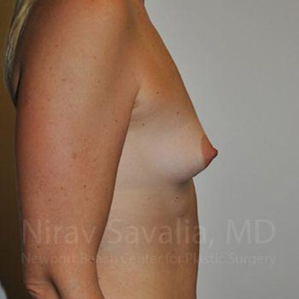 Mastectomy Reconstruction Before & After Gallery - Patient 1655512 - Before
