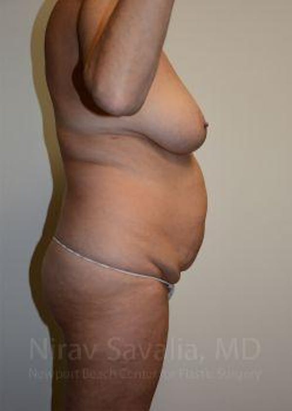 Breast Augmentation Before & After Gallery - Patient 1655515 - Before