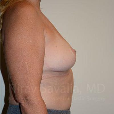 Abdominoplasty Tummy Tuck Before & After Gallery - Patient 1655523 - After