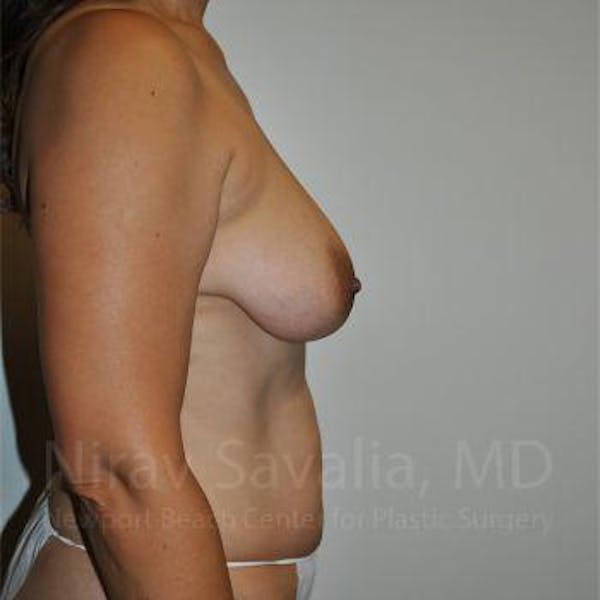 Breast Lift with Implants Before & After Gallery - Patient 1655542 - Before