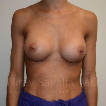 Breast Augmentation Before & After Gallery - Patient 1655548 - After