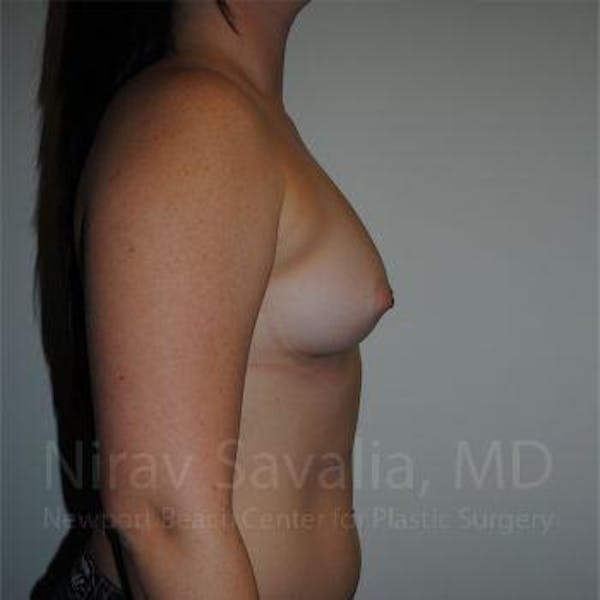 Breast Reduction Before & After Gallery - Patient 1655559 - Before