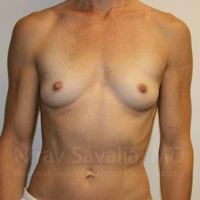 Facelift Before & After Gallery - Patient 1655561 - Before