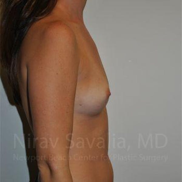 Breast Explantation En Bloc Capsulectomy Before & After Gallery - Patient 1655574 - Before