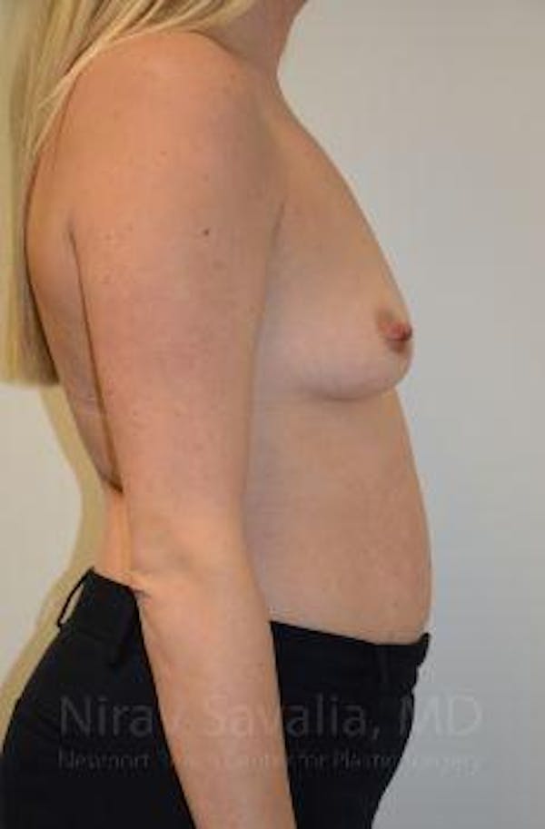 Breast Augmentation Before & After Gallery - Patient 1655585 - Before