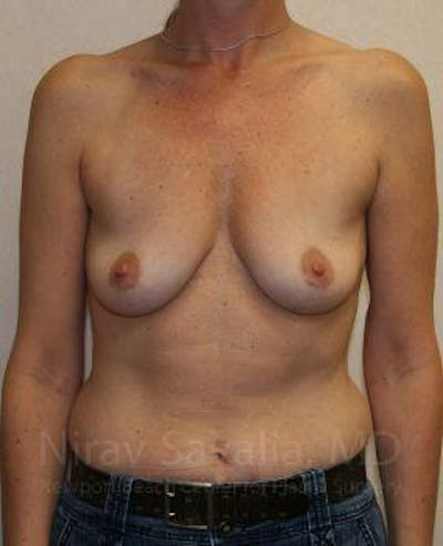 Body Contouring after Weight Loss Before & After Gallery - Patient 1655587 - Before