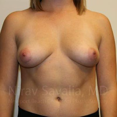 Oncoplastic Reconstruction Before & After Gallery - Patient 1655593 - Before