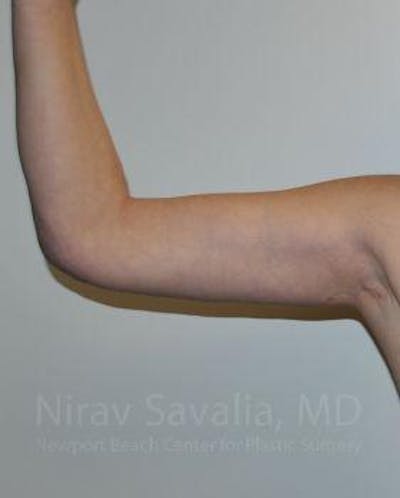 Liposuction Before & After Gallery - Patient 1655600 - After