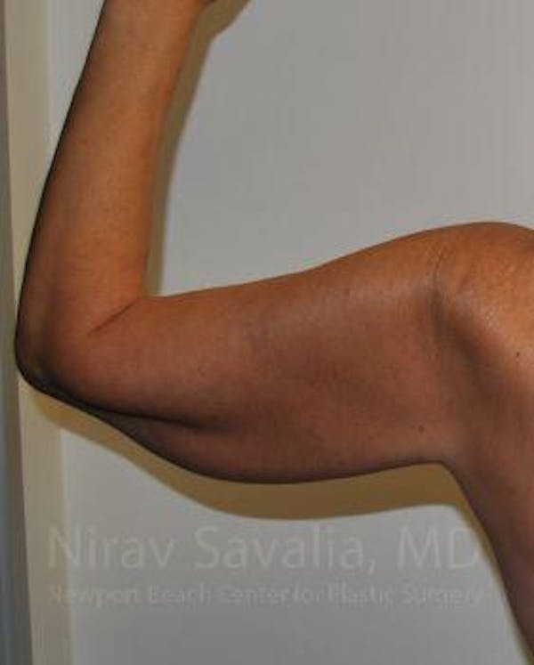 Liposuction Before & After Gallery - Patient 1655600 - Before