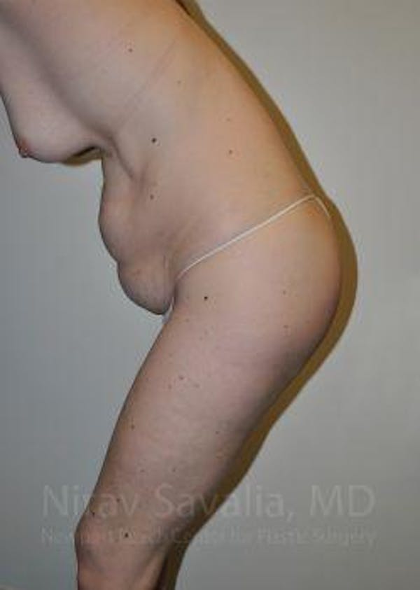 Facelift Before & After Gallery - Patient 1655603 - Before