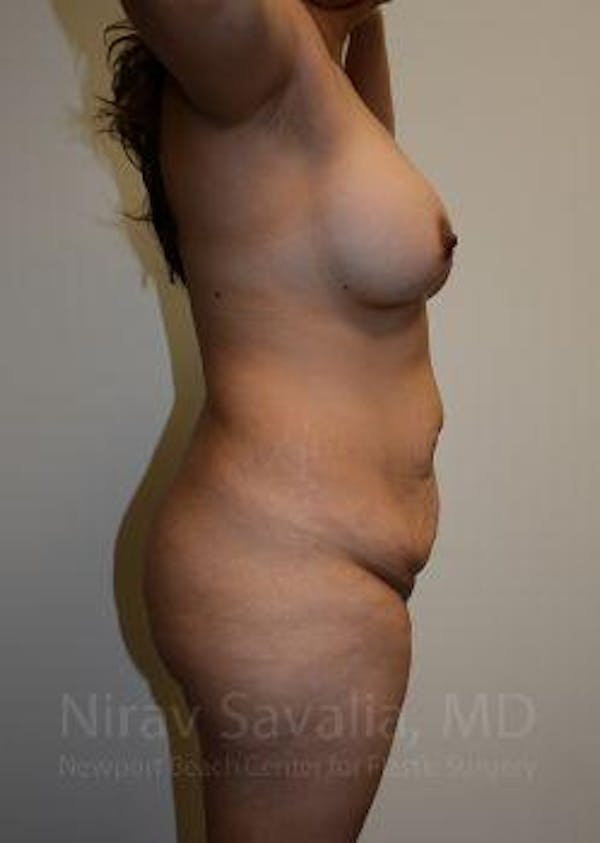 Breast Explantation En Bloc Capsulectomy Before & After Gallery - Patient 1655609 - Before