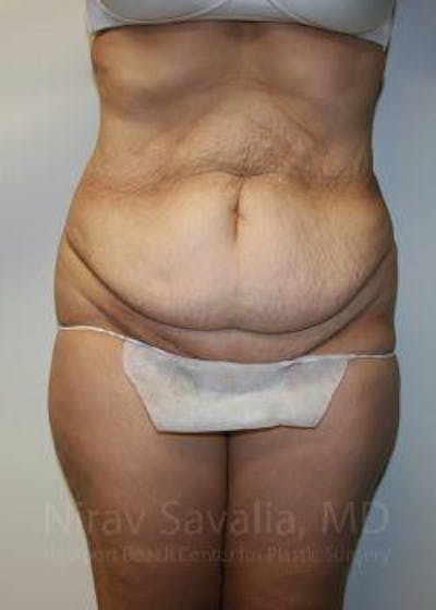 Abdominoplasty Tummy Tuck Before & After Gallery - Patient 1655611 - Before