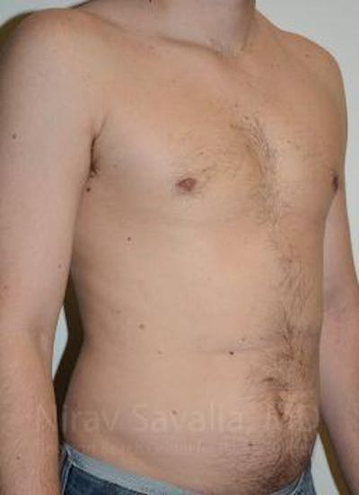 Breast Lift with Implants Before & After Gallery - Patient 1655612 - After