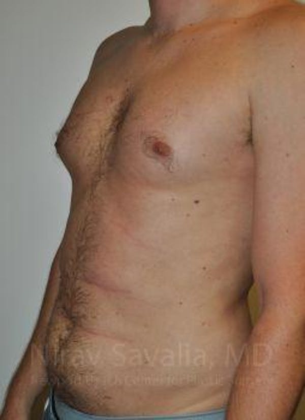 Breast Lift with Implants Before & After Gallery - Patient 1655612 - Before