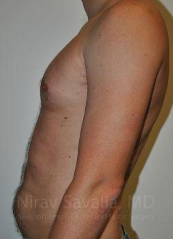 Liposuction Before & After Gallery - Patient 1655612 - Before