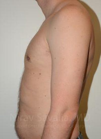 Liposuction Before & After Gallery - Patient 1655612 - After