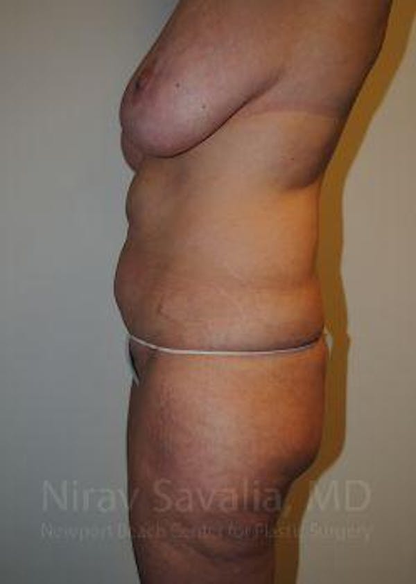 Mastectomy Reconstruction Before & After Gallery - Patient 1655623 - Before