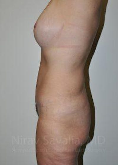 Mastectomy Reconstruction Before & After Gallery - Patient 1655623 - After