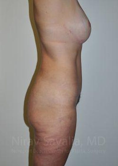 Mastectomy Reconstruction Before & After Gallery - Patient 1655623 - After