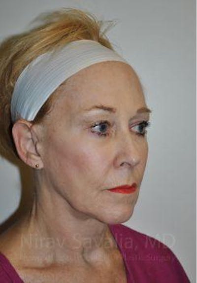 Facelift Before & After Gallery - Patient 1655625 - Before