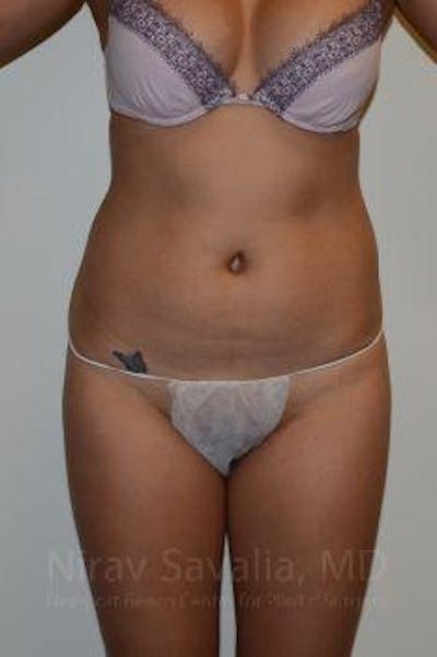 Breast Lift with Implants Before & After Gallery - Patient 1655637 - Before