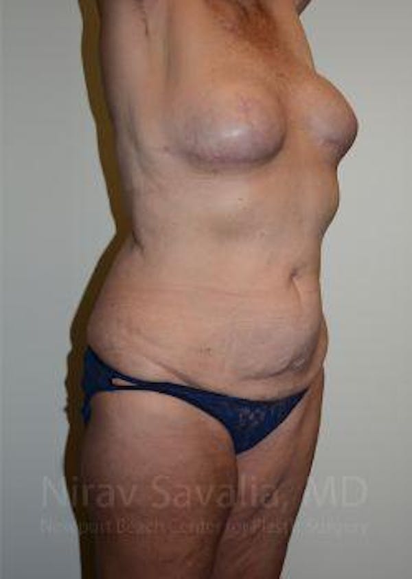 Breast Lift with Implants Before & After Gallery - Patient 1655634 - Before