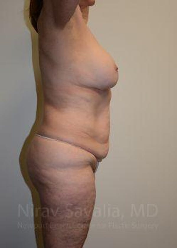 Mommy Makeover Before & After Gallery - Patient 1655639 - Before