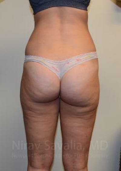 Abdominoplasty Tummy Tuck Before & After Gallery - Patient 1655642 - After