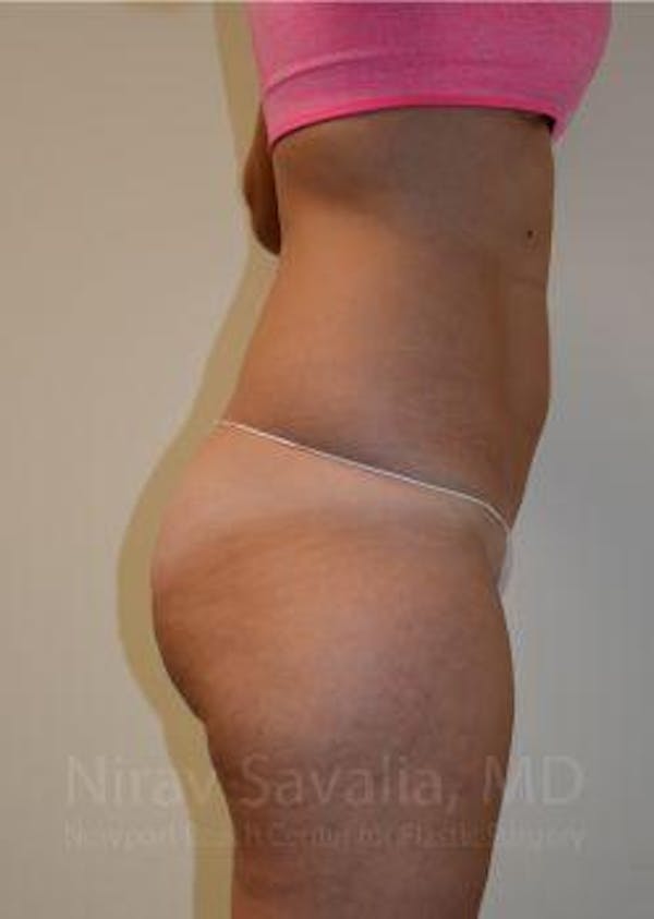 Abdominoplasty Tummy Tuck Before & After Gallery - Patient 1655642 - Before