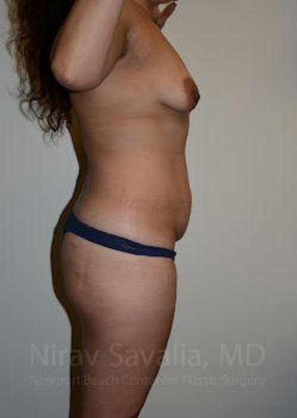 Mastectomy Reconstruction Before & After Gallery - Patient 1655641 - Before