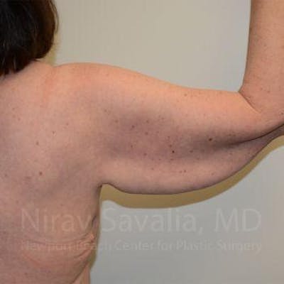 Breast Lift with Implants Before & After Gallery - Patient 1655643 - Before