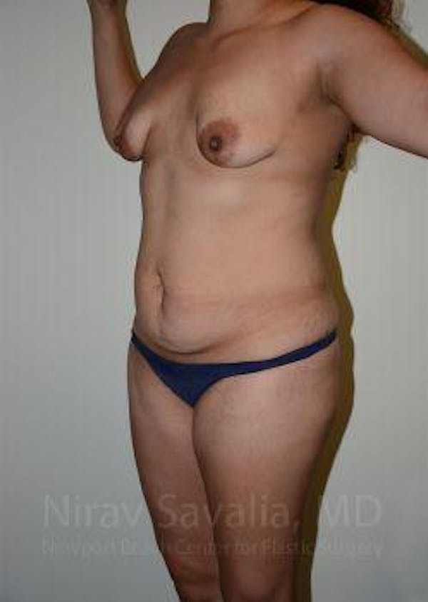 Mastectomy Reconstruction Before & After Gallery - Patient 1655641 - Before