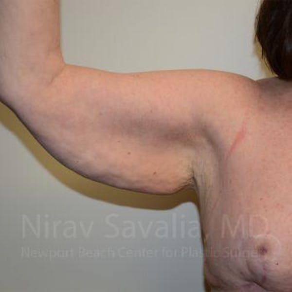 Breast Lift with Implants Before & After Gallery - Patient 1655643 - Before