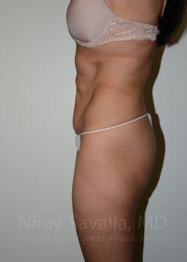 Abdominoplasty Tummy Tuck Before & After Gallery - Patient 1655645 - Before