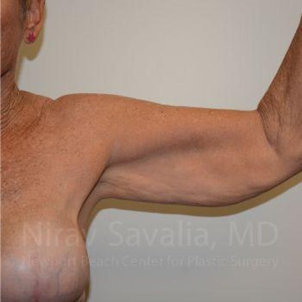 Breast Reduction Before & After Gallery - Patient 1655646 - Before