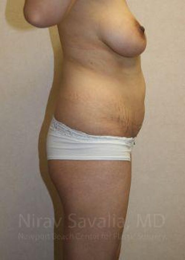 Body Contouring after Weight Loss Before & After Gallery - Patient 1655648 - Before