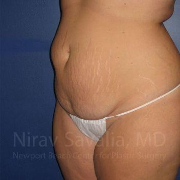 Breast Reduction Before & After Gallery - Patient 1655647 - Before
