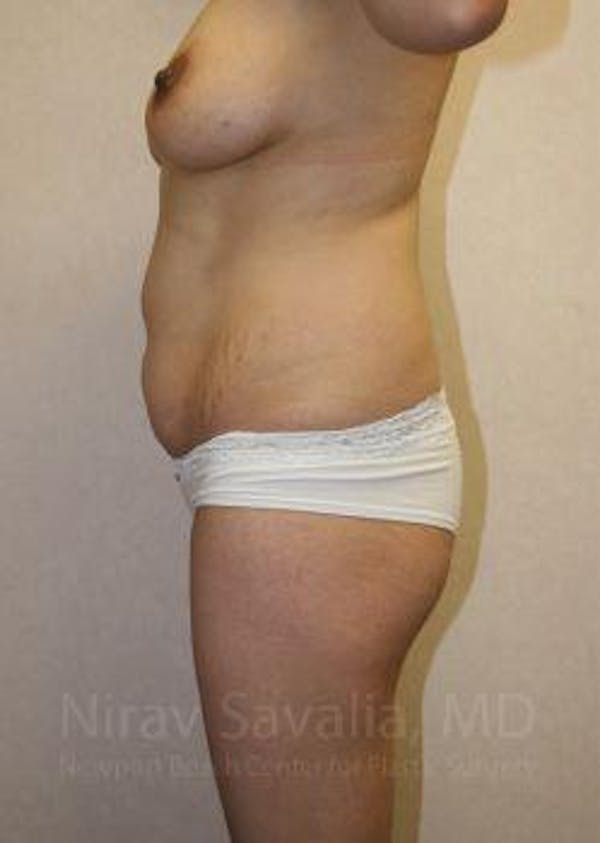 Body Contouring after Weight Loss Before & After Gallery - Patient 1655648 - Before