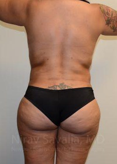 Abdominoplasty Tummy Tuck Before & After Gallery - Patient 1655657 - After